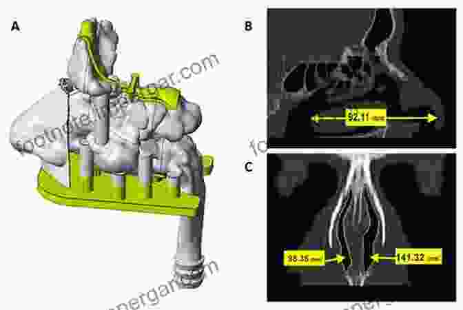 3D Printed Nasal Implant, Demonstrating The Potential Of Biomedical Engineering In Reconstructive Surgery. Clinical And Biomedical Engineering In The Human Nose: A Computational Fluid Dynamics Approach (Biological And Medical Physics Biomedical Engineering)